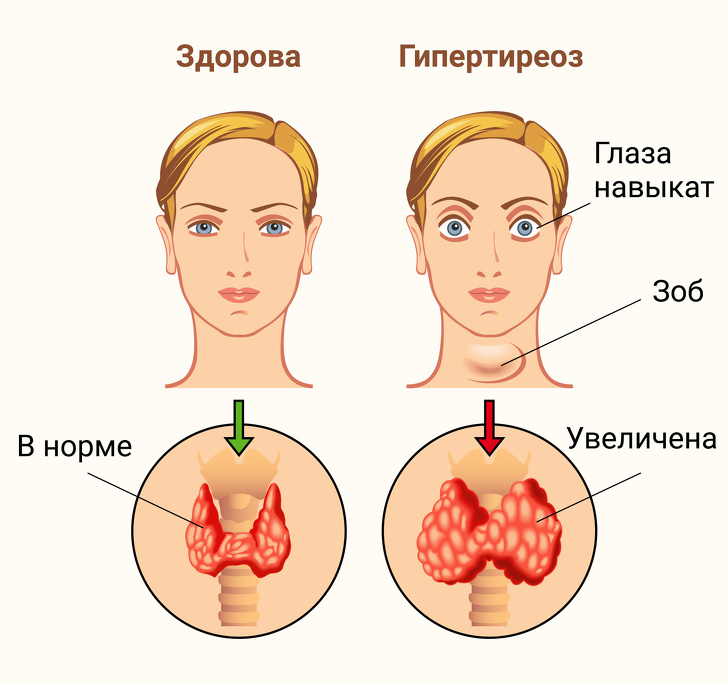 Гормоны щитовидной железы. Тиреокальцитонин. Нарушение функции щитовидной железы