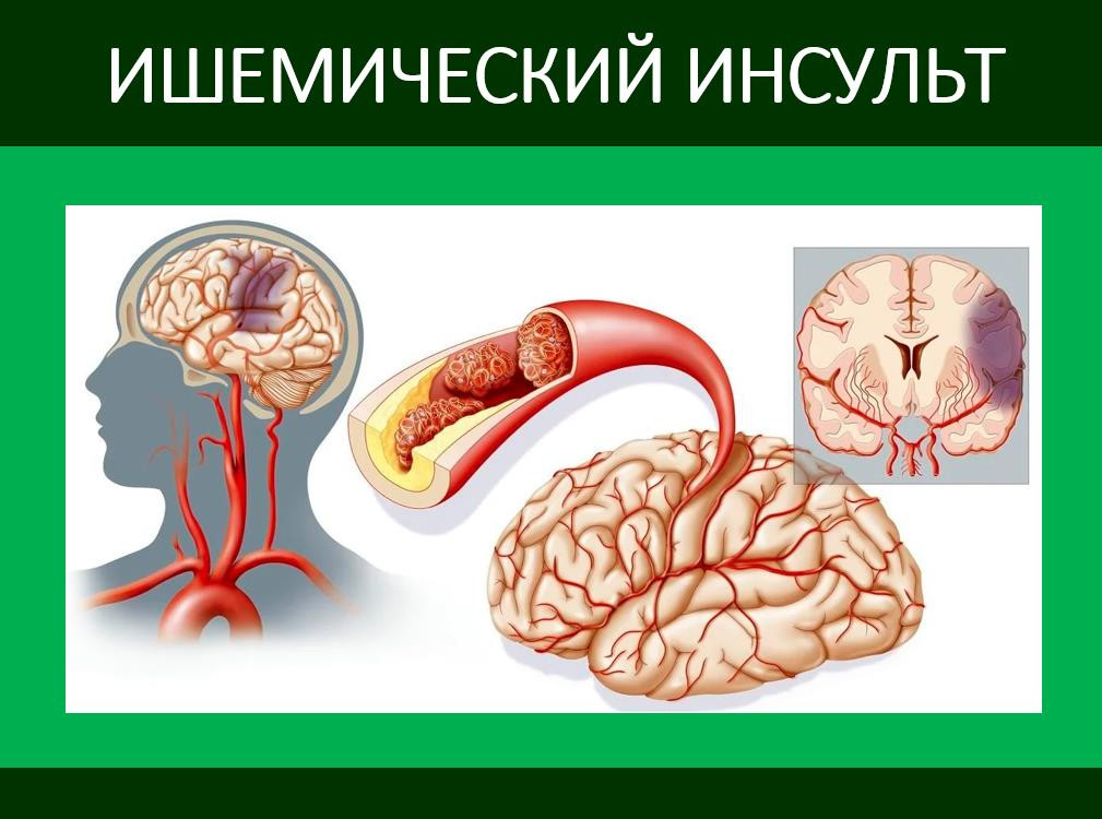 Ишемический инсульт головного мозга. Ишемический инсульт картинки. Начало ишемического инсульта.