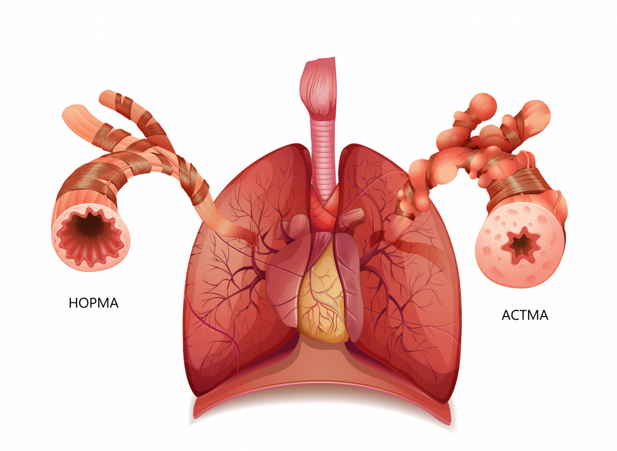 Бронхиальная астма. Бронхиальная астма отек легких