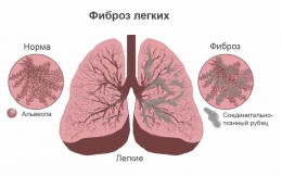 Легкие под ударом: что такое фиброз и как защитить главный орган дыхания Легкие под ударом: что такое фиброз и как защитить главный орган дыхания