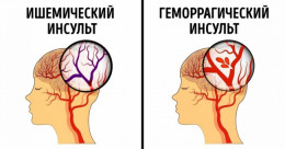 Что такое инсульт?